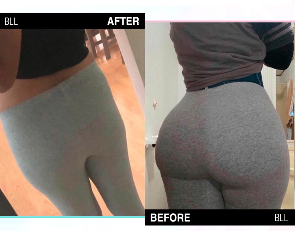 sassy queen recovery after and before bbl or tummy tuck?